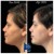 Pan Face Filler treatment 20 thumbnail