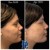 Pan Face Filler treatment 21 thumbnail