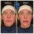 Pan Face Filler treatment 22 thumbnail