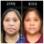 Pan Face Filler treatment 23 thumbnail
