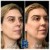 Pan Face Filler treatment 3 thumbnail