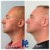 Pan Face Filler treatment 8 thumbnail