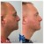 Pan Face Filler treatment 9 thumbnail