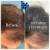 PRP Hair Treatment 1 thumbnail