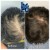 PRP Hair Treatment 10 thumbnail