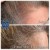 PRP Hair Treatment 2 thumbnail
