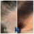 PRP Hair Treatment 3 thumbnail