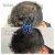 PRP Hair Treatment 4 thumbnail