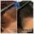 PRP Hair Treatment 5 thumbnail