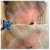 PRP Hair Treatment 7 thumbnail