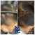 PRP Hair Treatment 9 thumbnail