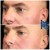 Radiesse® treatment 1 thumbnail
