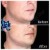 Radiesse® treatment 11 thumbnail