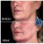 Radiesse® treatment 14 thumbnail