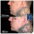 Radiesse® treatment 15 thumbnail