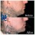 Radiesse® treatment 16 thumbnail