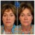 Radiesse® treatment 18 thumbnail