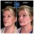 Radiesse® treatment 19 thumbnail