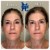 Radiesse® treatment 20 thumbnail