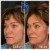 Radiesse® treatment 23 thumbnail