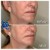 Radiesse® treatment 24 thumbnail