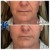 Radiesse® treatment 25 thumbnail