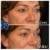 Radiesse® treatment 26 thumbnail
