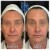 Radiesse® treatment 27 thumbnail