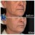 Radiesse® treatment 28 thumbnail
