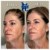 Radiesse® treatment 29 thumbnail