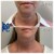 Radiesse® treatment 6 thumbnail