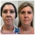 Radiesse® treatment 8 thumbnail