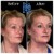 Radiesse® treatment 9 thumbnail