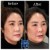 Sculptra® treatment 1 thumbnail