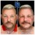 Sculptra® treatment 10 thumbnail