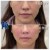 Sculptra® treatment 2 thumbnail