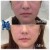 Sculptra® treatment 3 thumbnail