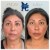 Sculptra® treatment 4 thumbnail