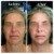 Sculptra® treatment 6 thumbnail