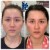 Sculptra® treatment 7 thumbnail