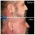 Sculptra® treatment 8 thumbnail