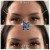 Upper Face Filler treatment 10 thumbnail