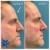 Upper Face Filler treatment 12 thumbnail