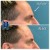 Upper Face Filler treatment 13 thumbnail