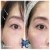 Upper Face Filler treatment 16 thumbnail