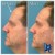 Upper Face Filler treatment 18 thumbnail