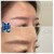 Upper Face Filler treatment 19 thumbnail