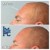 Upper Face Filler treatment 2 thumbnail