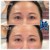 Upper Face Filler treatment 20 thumbnail
