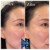 Upper Face Filler treatment 21 thumbnail